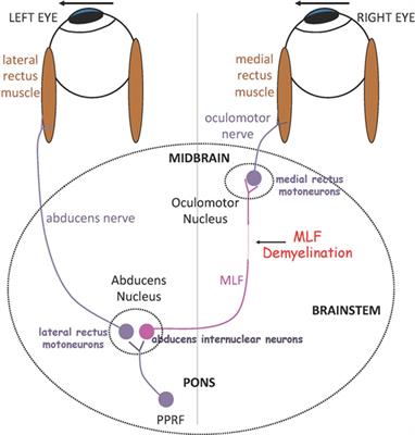 Eye Movement Abnormalities in Multiple Sclerosis: Pathogenesis, Modeling, and Treatment